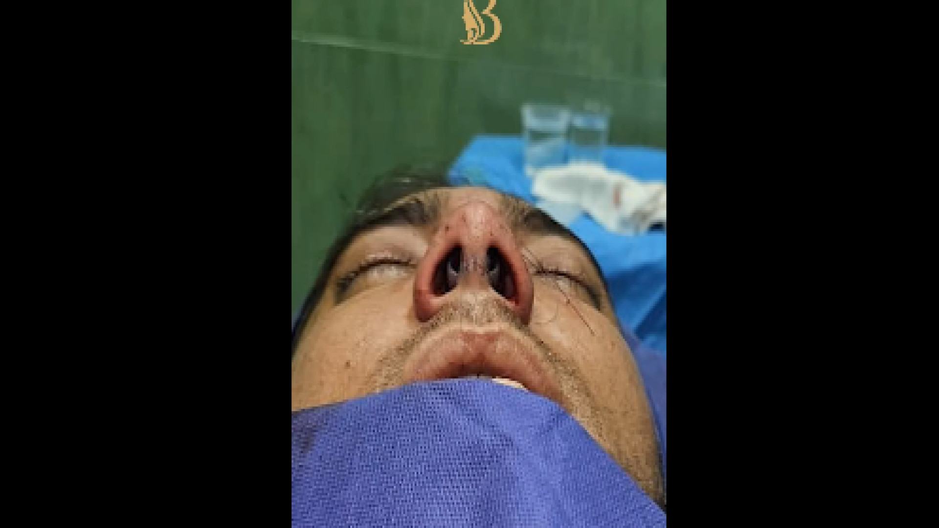 رینوپلاستی مردانه در بینی با انحراف تیغه دکتر سهیل برومند