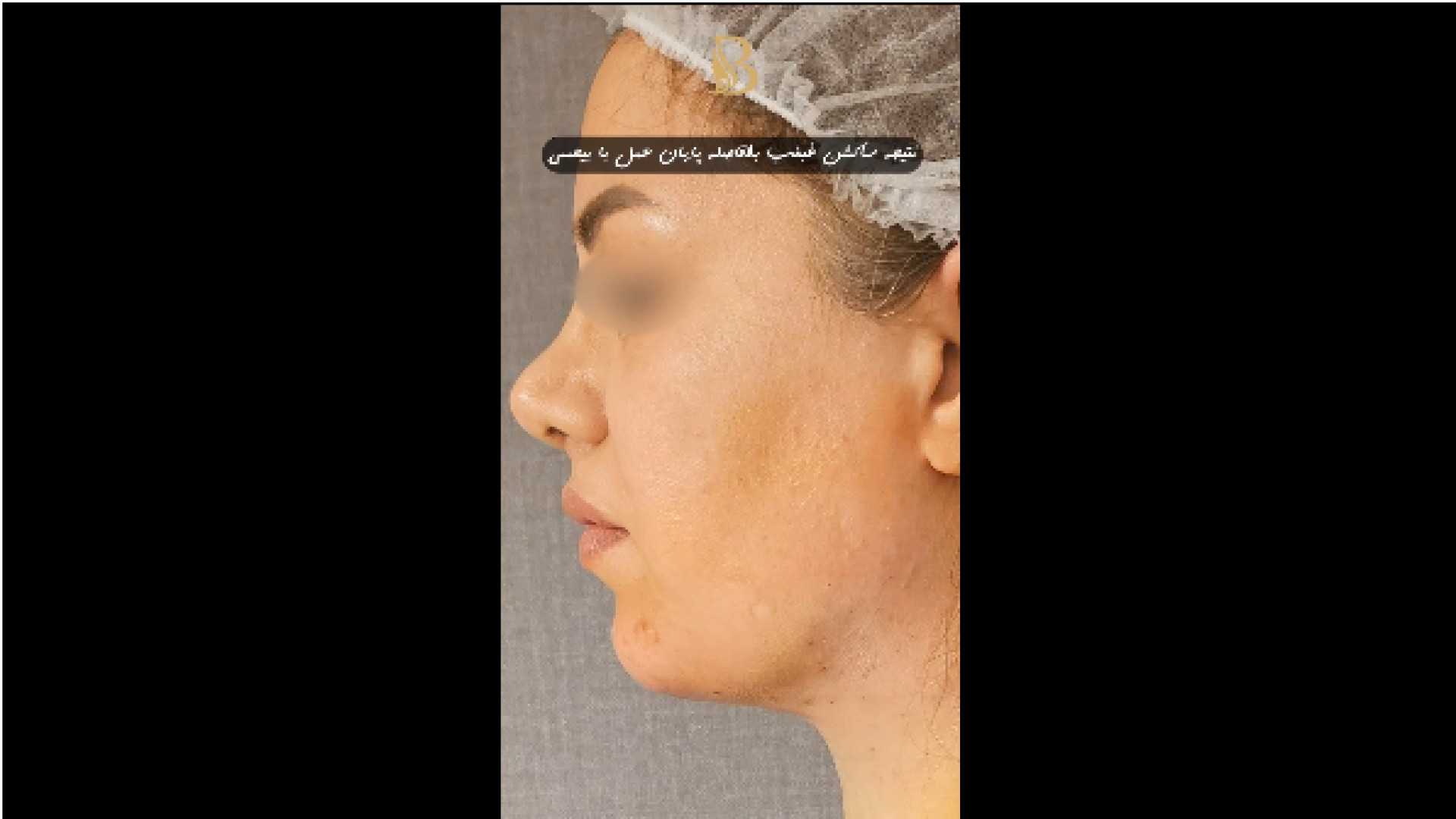 ساکشن غبغب دکتر سهیل برومند