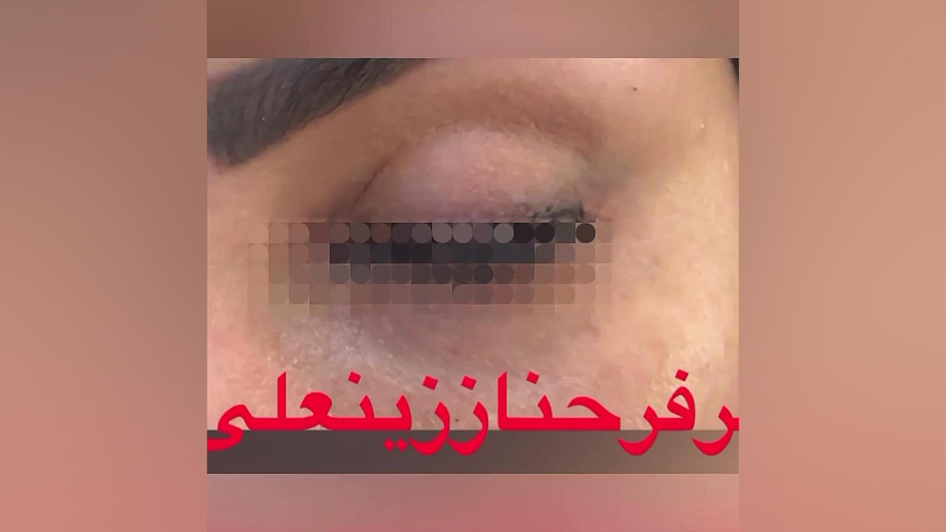 نتیجه جراحی بلفاروپلاستی پلک بالا دکتر فرحناز زینعلی - متخصص پوست، مو، زیبایی زنجان