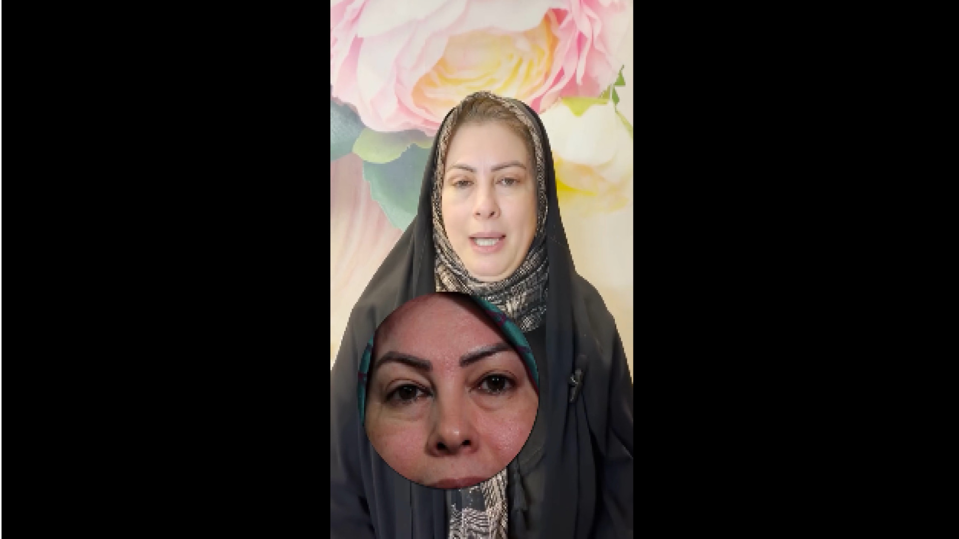 عمل پلک بدون بخیه دکتر شاهین بهجو - فوق تخصص جراحی پلاستیک
