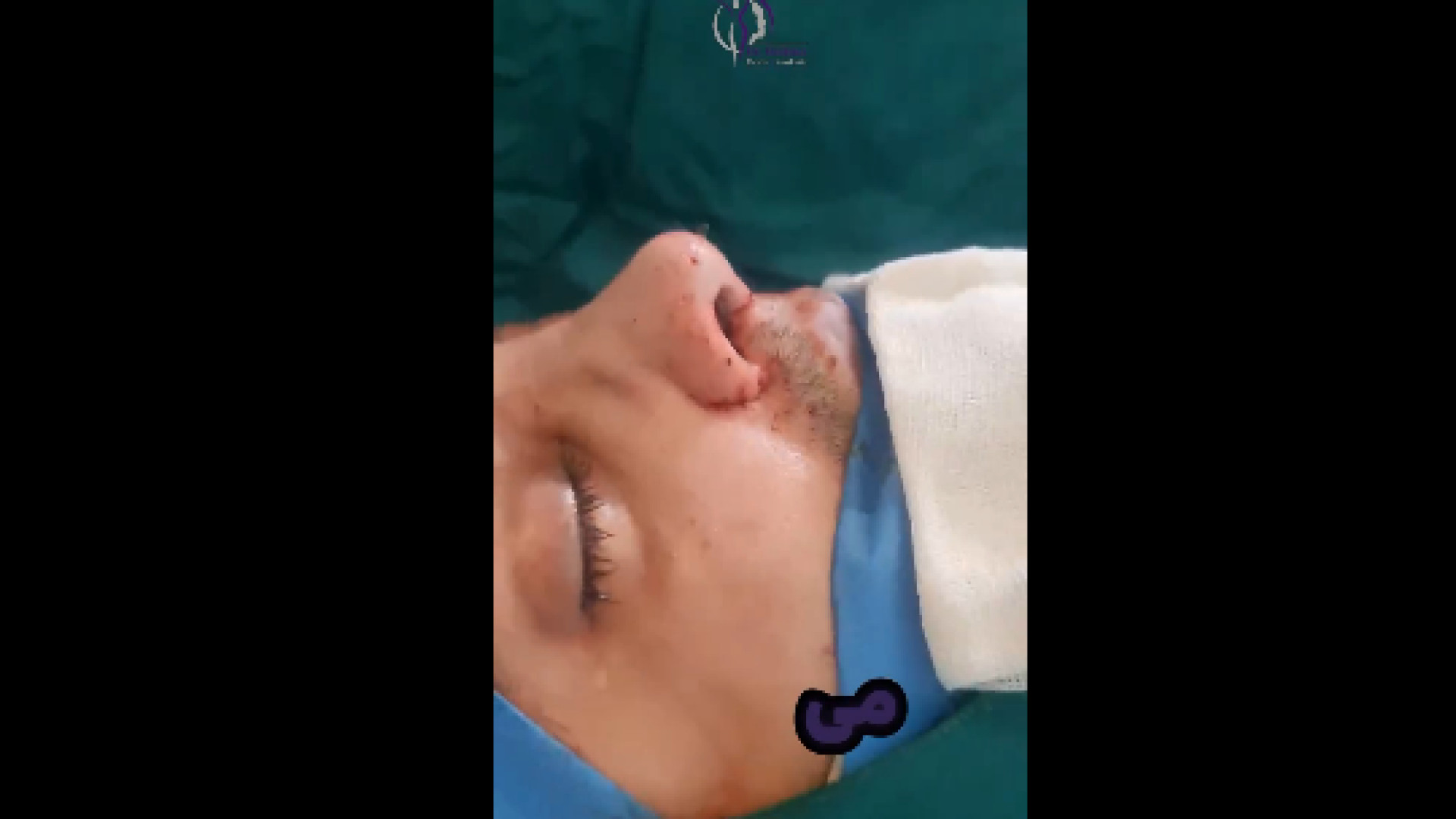 عمل بینی شکسته دکتر شاهین بهجو - فوق تخصص جراحی پلاستیک