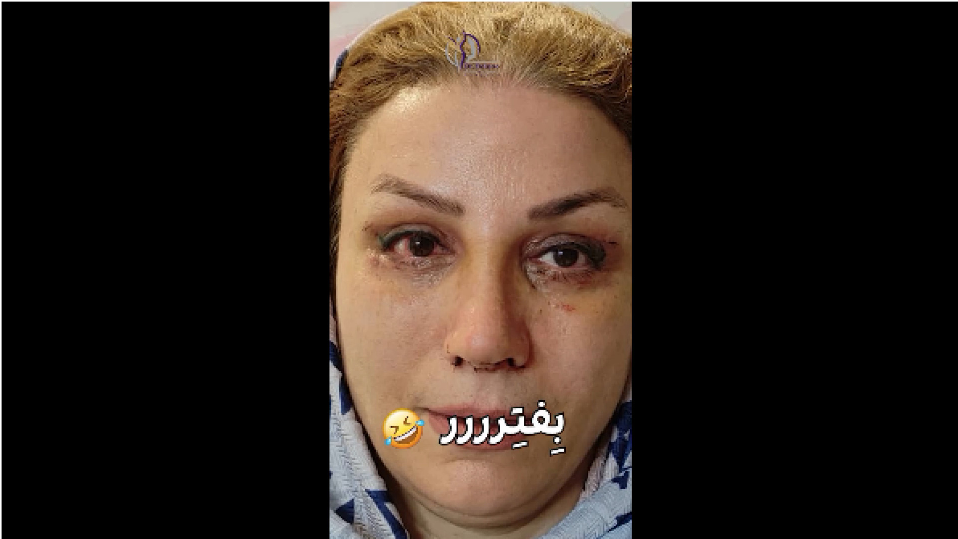بلفاروپلاستی و لیفت صورت دکتر شاهین بهجو - فوق تخصص جراحی پلاستیک