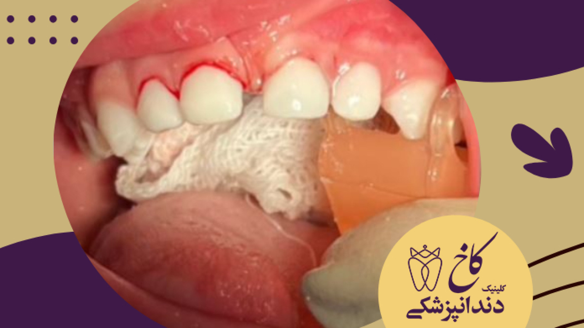ترمیم دندان شیری کلینیک دندانپزشکی کاخ