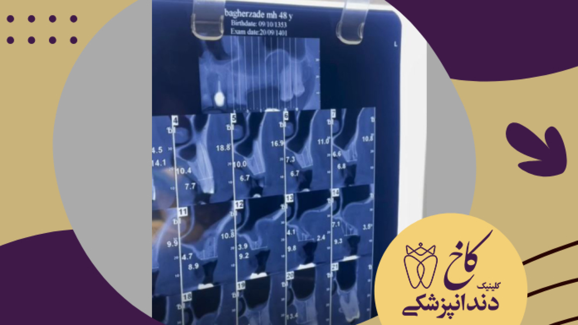 عفونت بسیار شدید دندان کلینیک دندانپزشکی کاخ