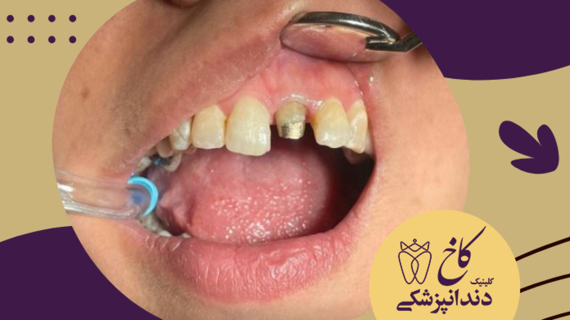 روکش دندان کلینیک دندانپزشکی کاخ