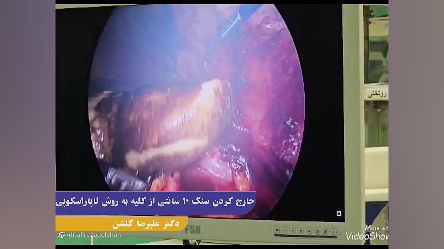سنگ کلیه 10 سانتی دکتر علیرضا گلشن فوق تخصص کلیه