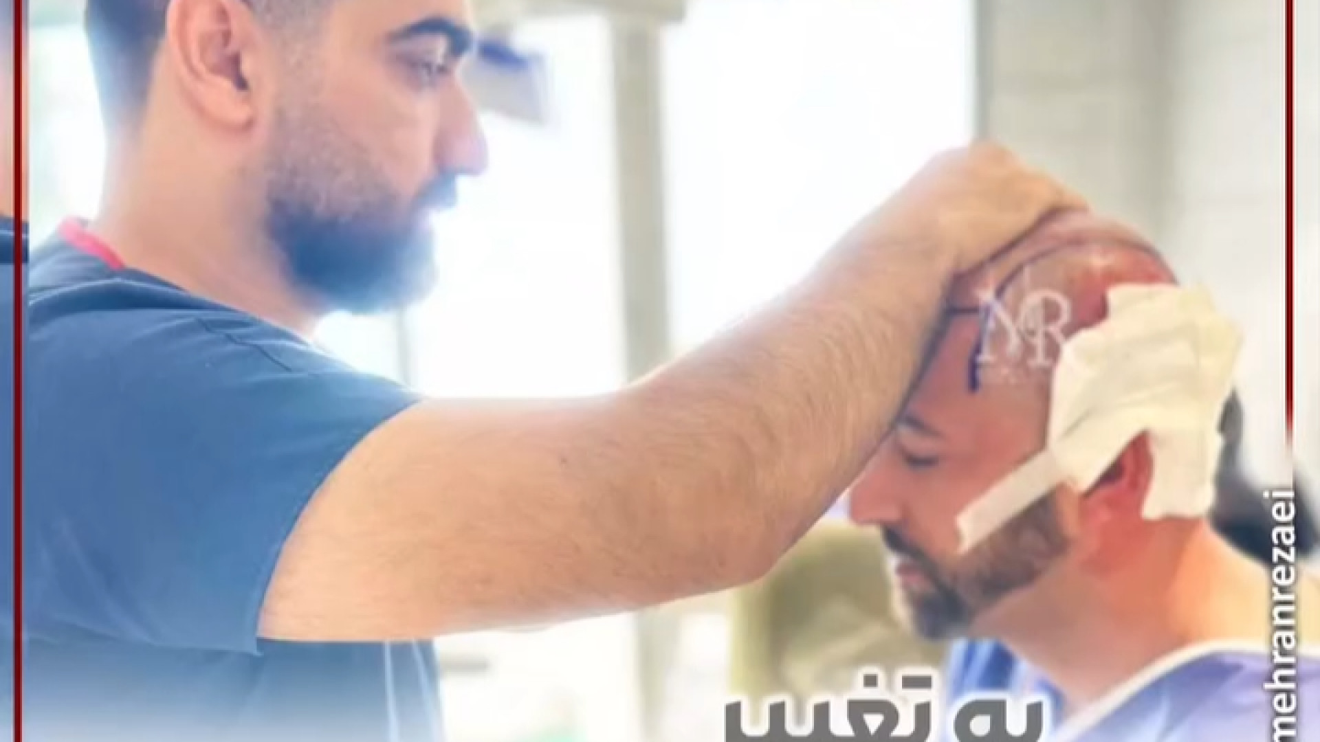 تغیرات پس از کاشت مو | کلینیک مهران رضایی پزشکی ویرایش ژن