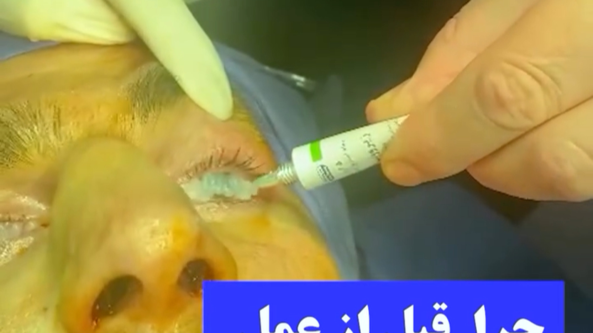 علت پماد زدن چشم قبل از عمل بینی دکتر جواد رحمتی