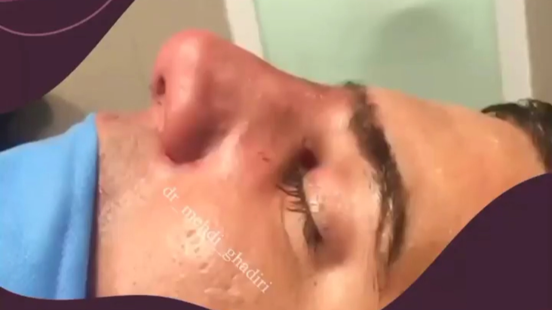 رینوپلاستی متناسب با صورت | دکتر مهدی قدیری دکتر مهدی قدیری