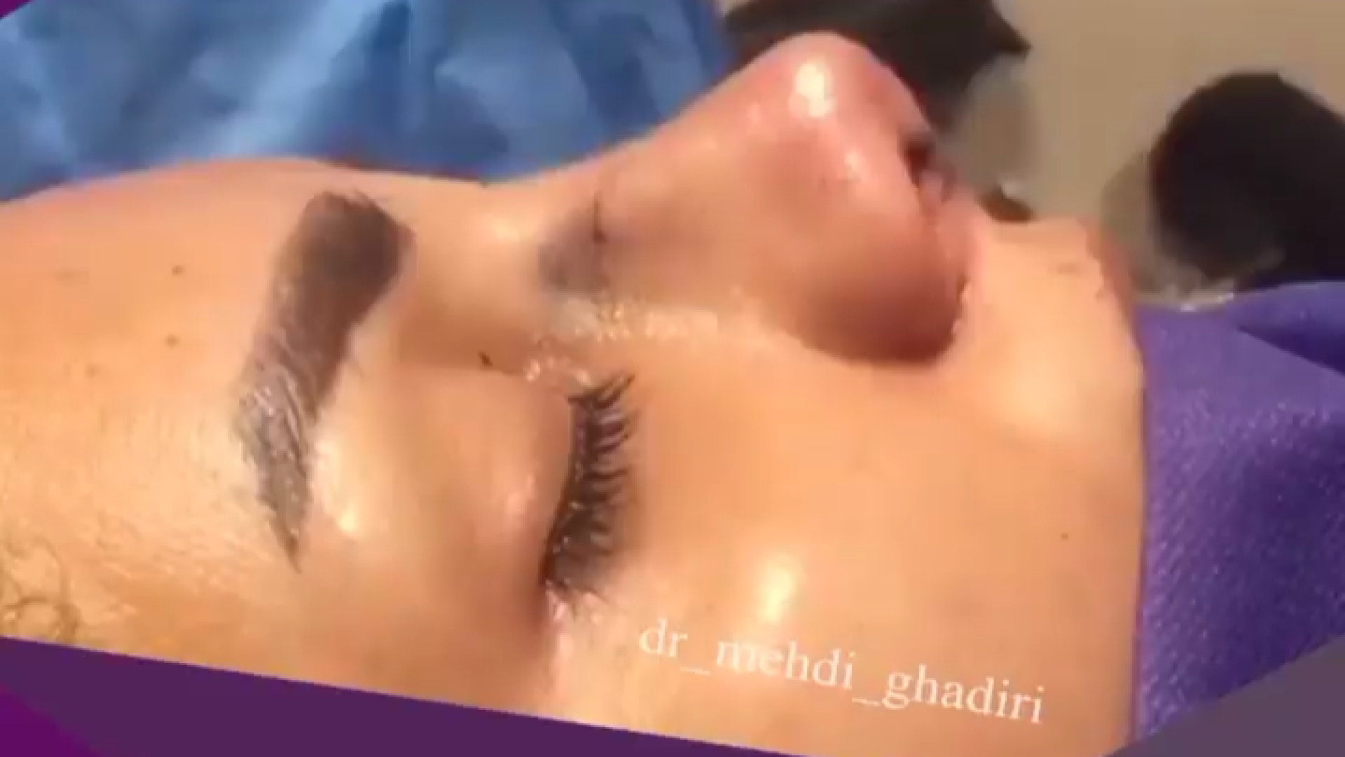 بینی نیمه فانتزی | دکتر مهدی قدیری دکتر مهدی قدیری