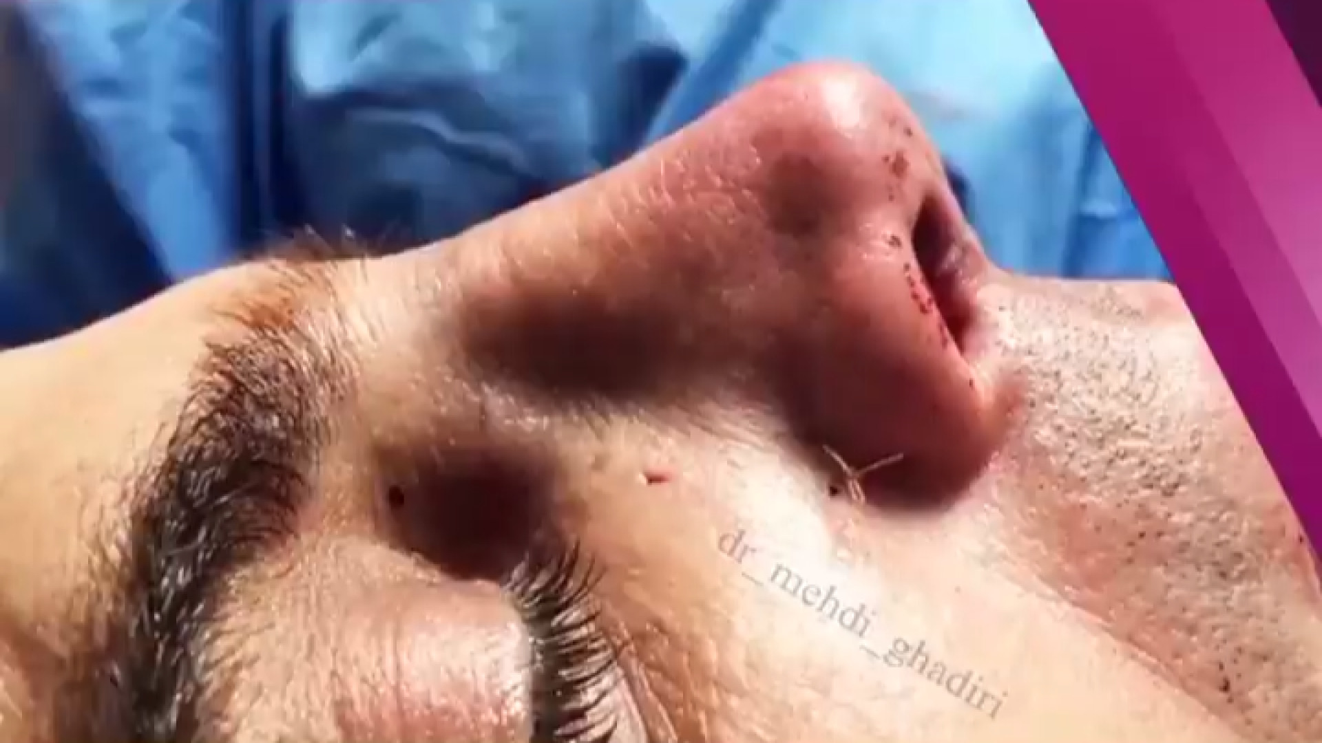 عمل بینی مردانه و طبیعی | دکتر مهدی قدیری دکتر مهدی قدیری