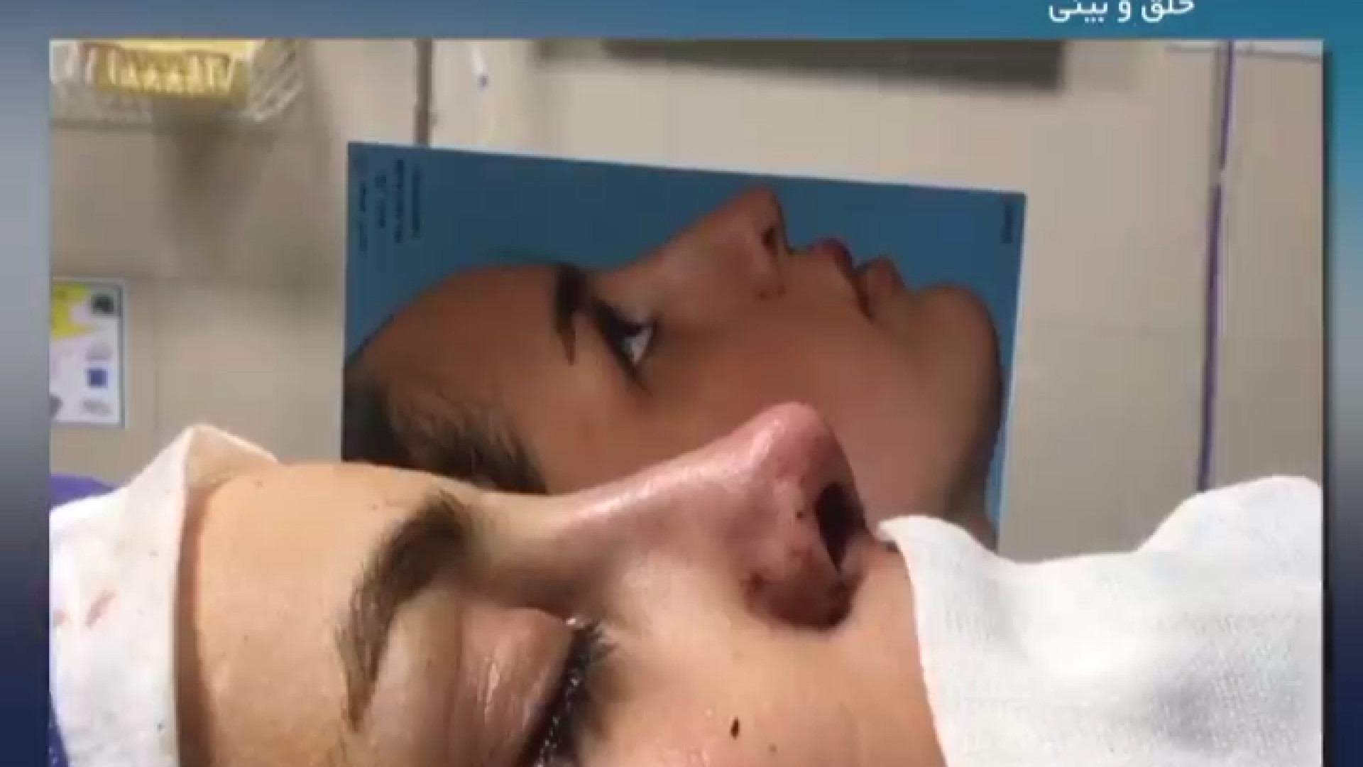 بلافاصله پس از رینوپلاستی | دکتر مهدی قدیری دکتر مهدی قدیری