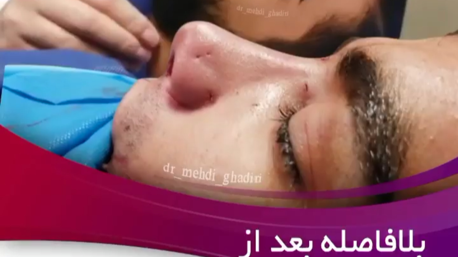 نتیجه جراحی بینی مردانه | دکتر مهدی قدیری دکتر مهدی قدیری