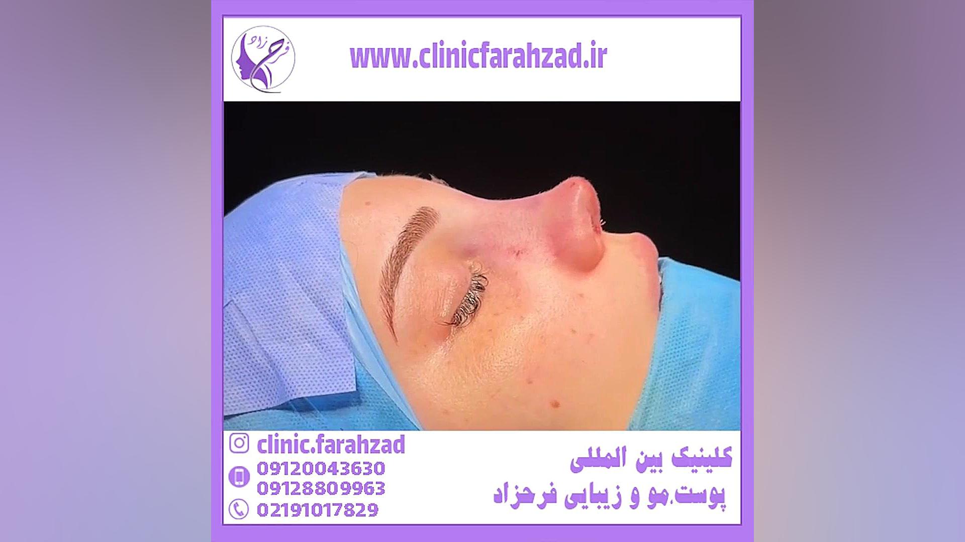 تزریق کورتون بعد از جراحی بینی روکش دندان