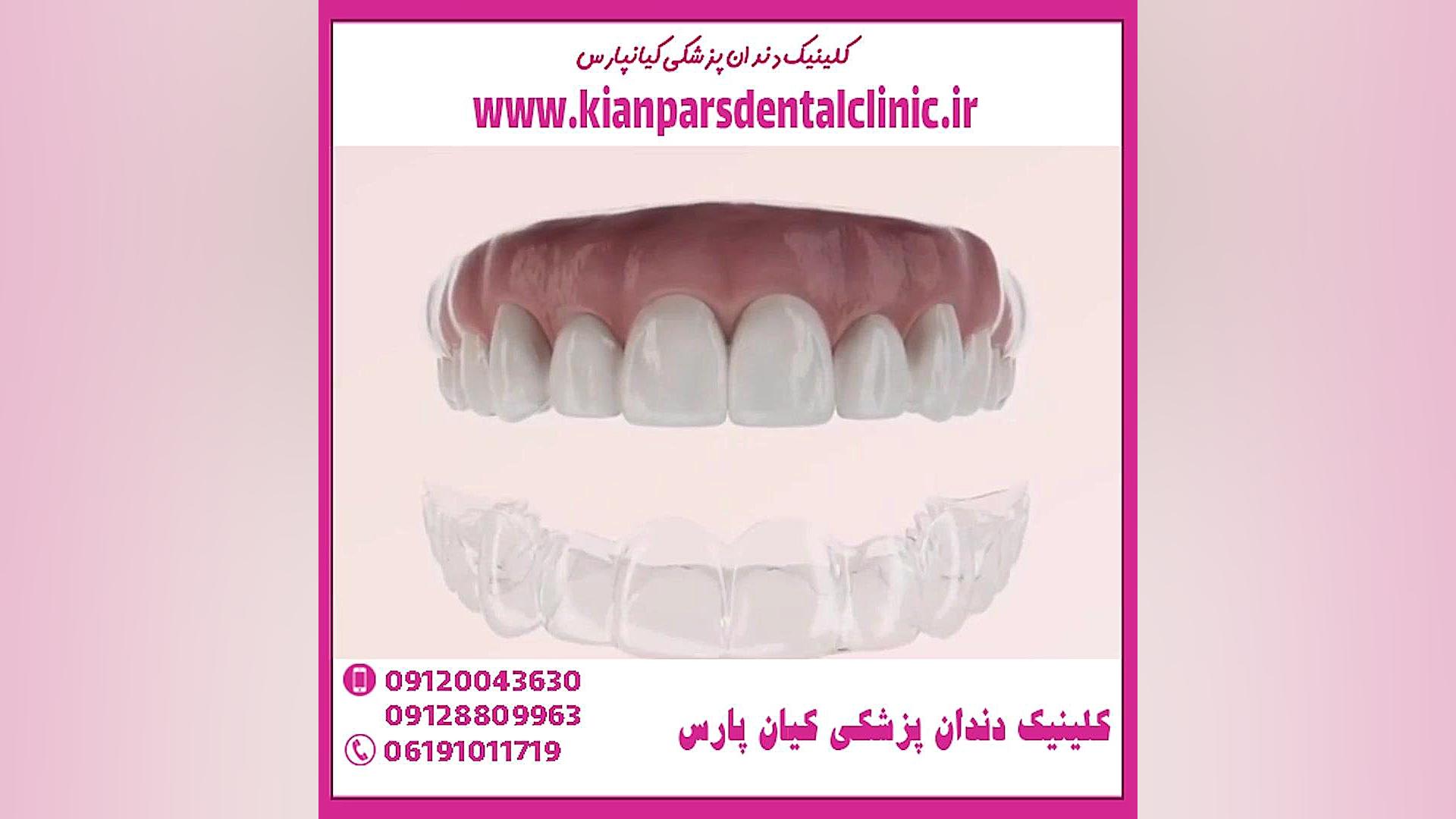 قیمت پروتز دندان متحرک ژله ای عصب‌کشی