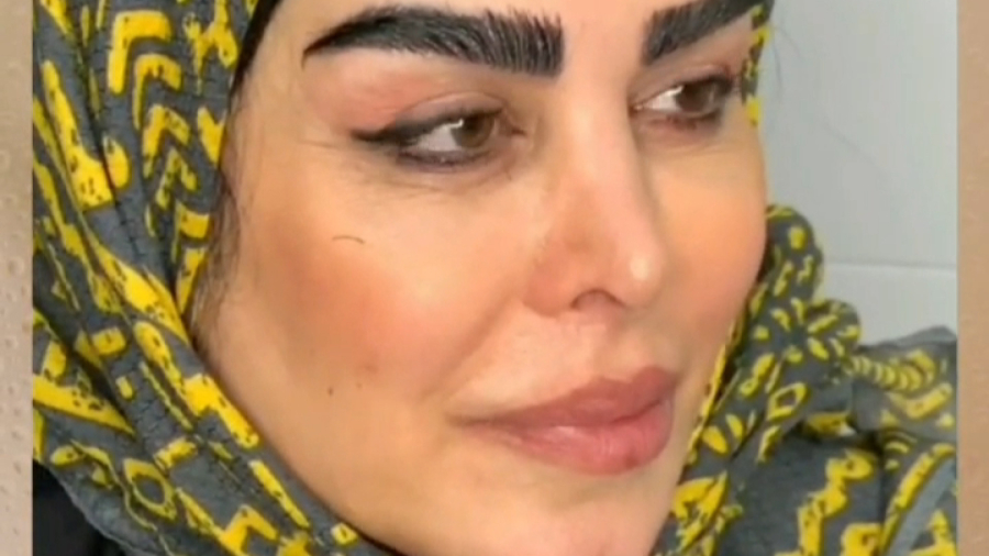 کاشت ابرو | فلور نظری| کلینیک راز آفرینش | ۰۹۳۳۶۵۶۶۸۵۹