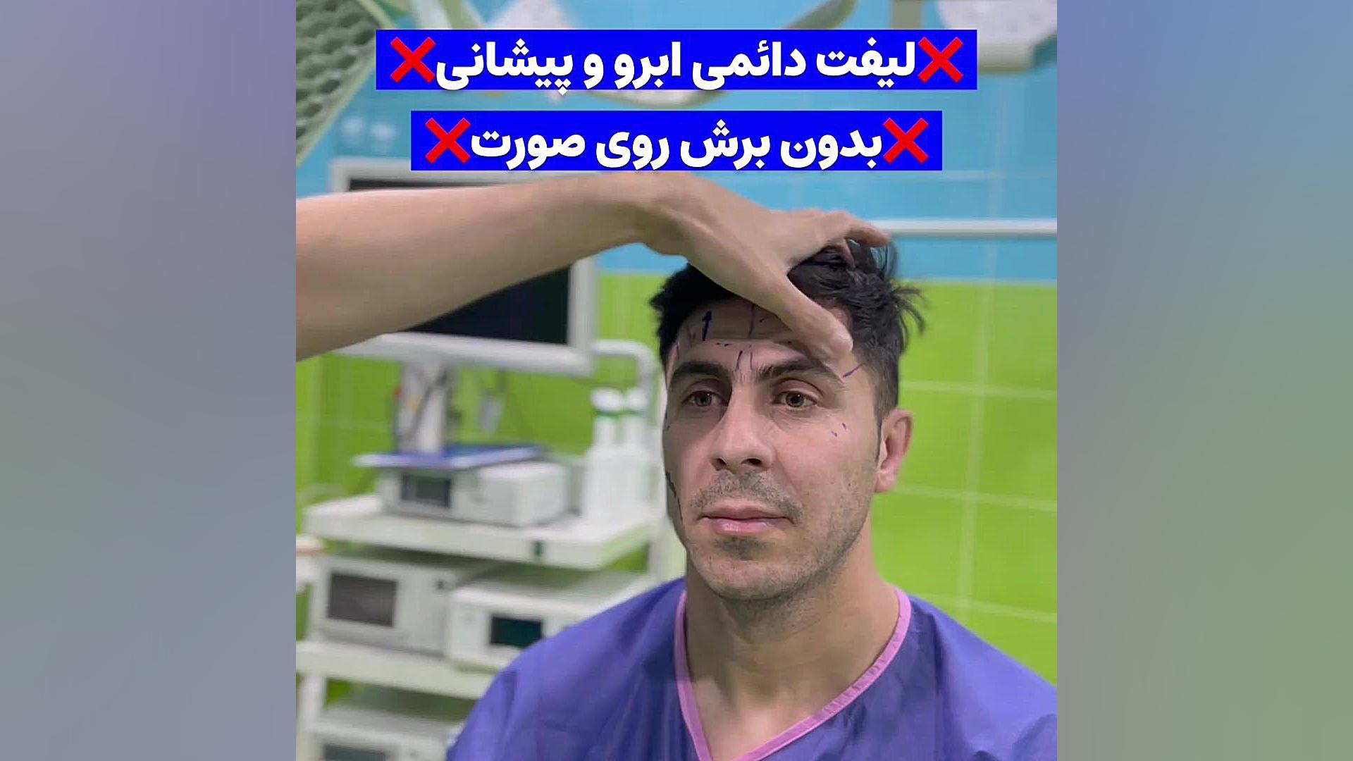 لیفت آندوسکوپی ابرو پیشانی وشقیقه Endoscopic browlift دکترامین رضازاده فوق تخصص جراحی پلاستیک