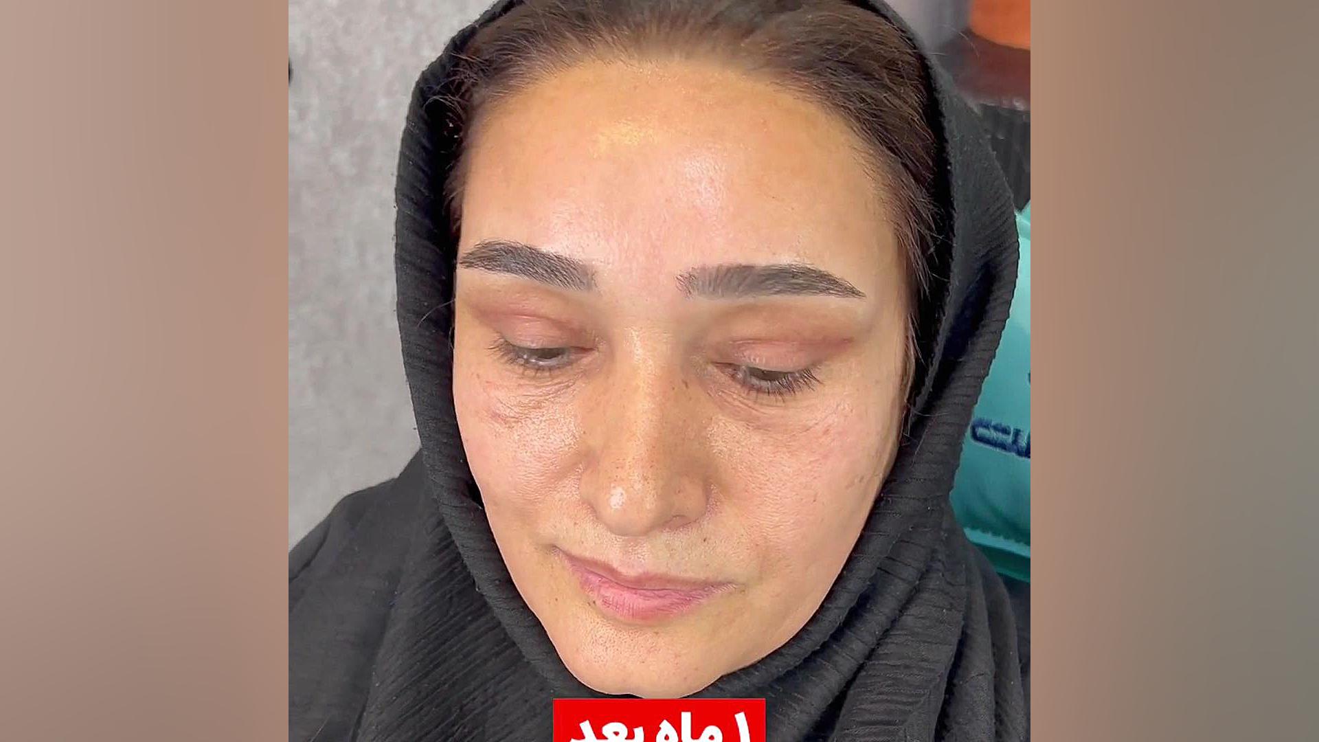 لیفت آندوسکوپی ابرو پیشانی شقیقه وبلفاروپلاستی Endoscopic browlift دکترامین رضازاده فوق تخصص جراحی پلاستیک