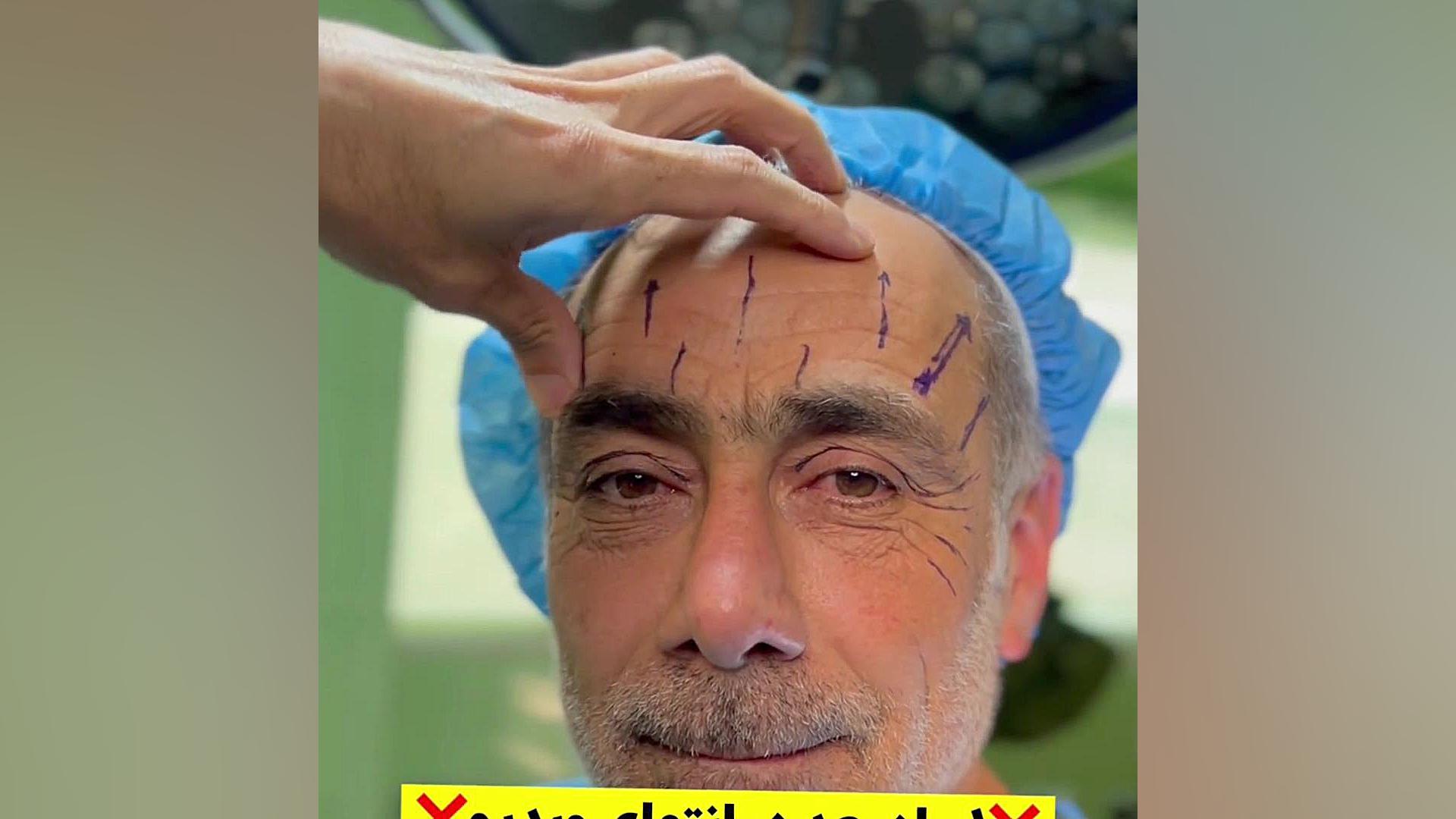 لیفت آندوسکوپی ابرو پیشانی وشقیقه وبلفاروپلاستی دکترامین رضازاده فوق تخصص جراحی پلاستیک