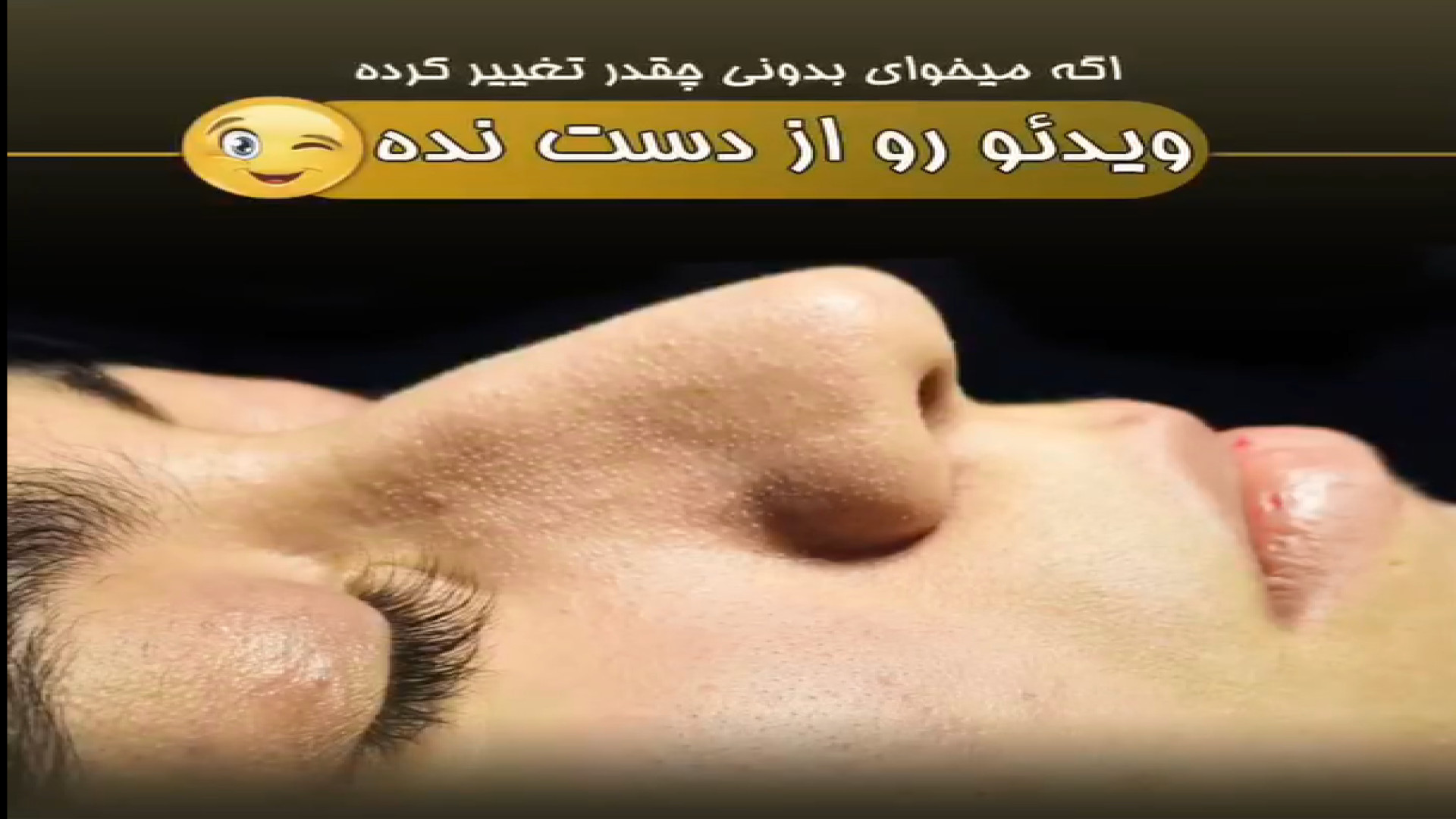 سپتورینوپلاستی بینی نیمه گوشتی دکتر علی عقیلی - جراح بینی در تهران