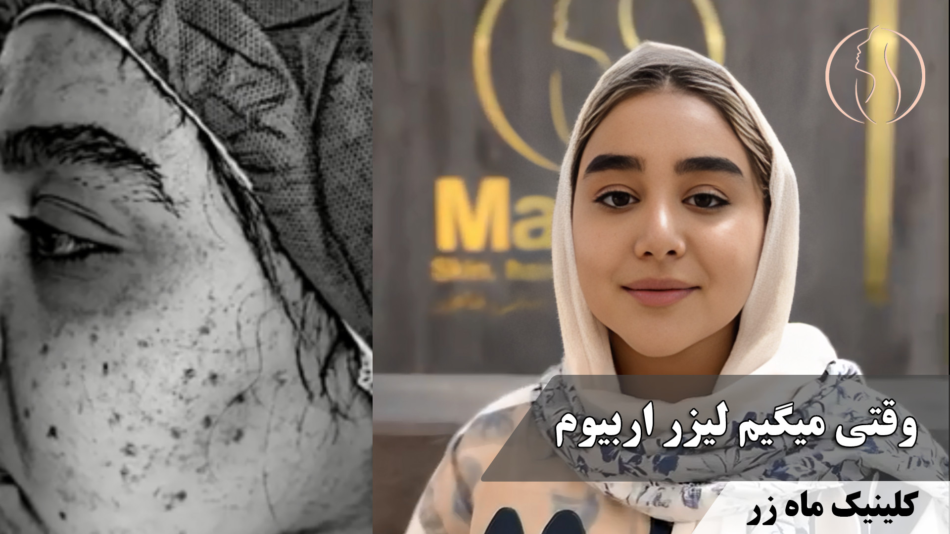 مثل پرتغال بود شد مثله پنبه ( کلینیک زیبایی ماه زر ) کاتاپلکسی