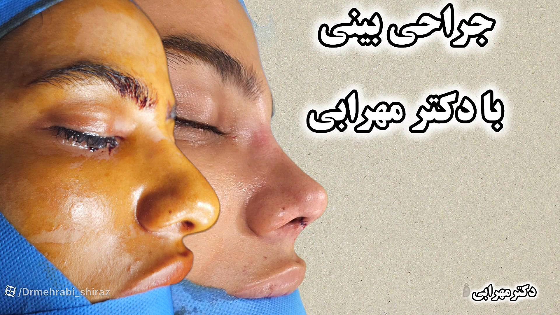 جراحی بینی گوشتی در شیراز دکتر مهرابی فوق تخصص جراحی پلاستیک دکتر محمد مهدی مهرابی جراح پلاستیک و زیبایی