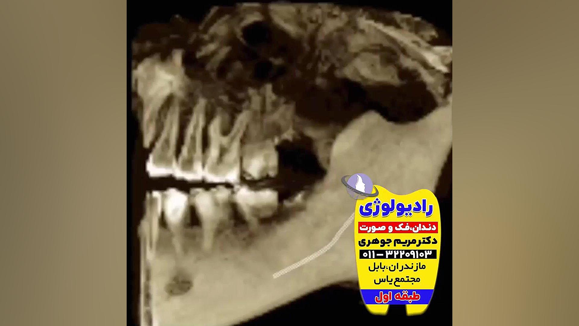 رادیولوژی فک و صورت بابل | دکتر مریم جوهری دکتر مریم جوهری