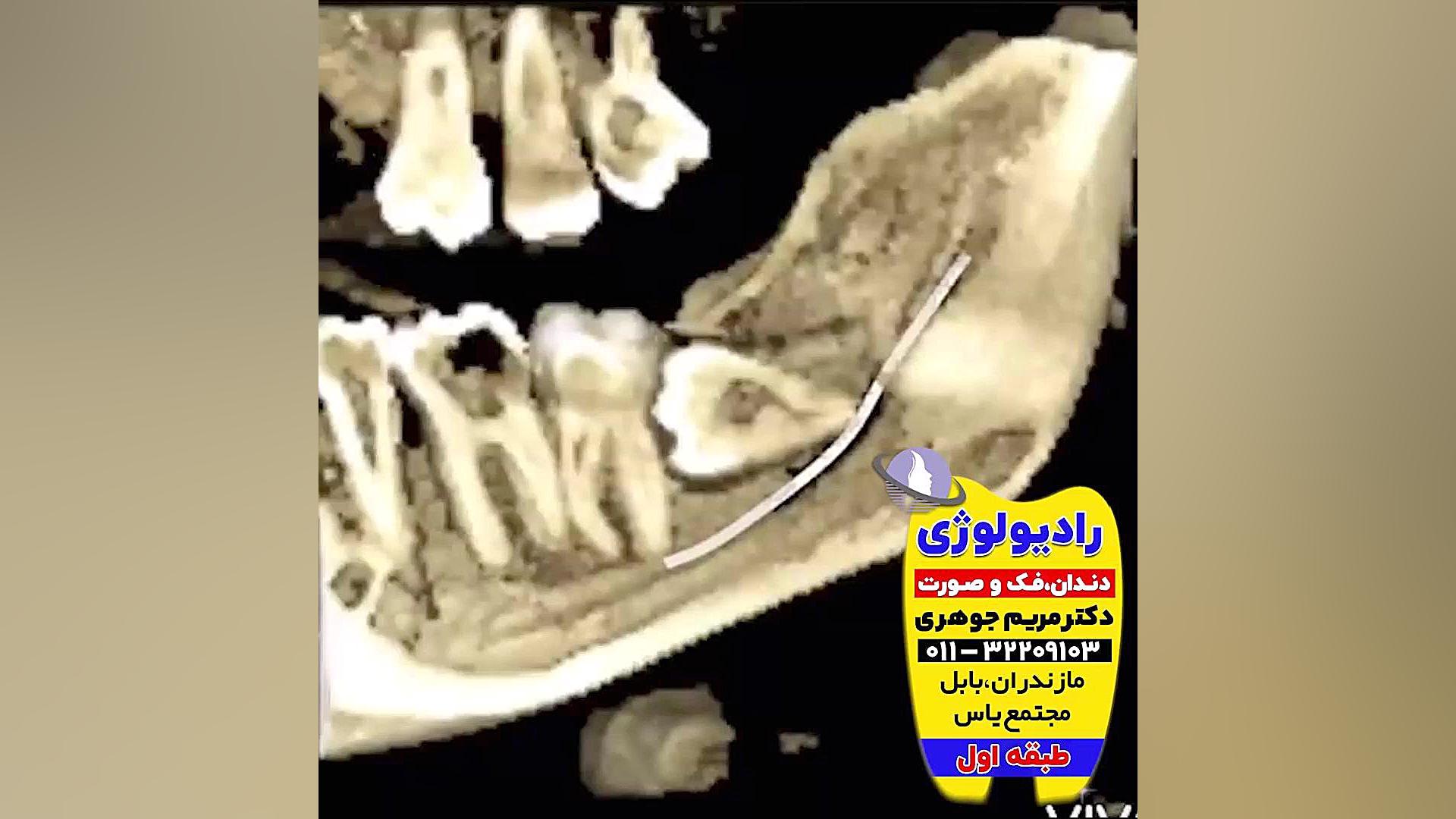 بهترین رادیولوژی فک و صورت بابل | دکتر مریم جوهری دکتر مریم جوهری
