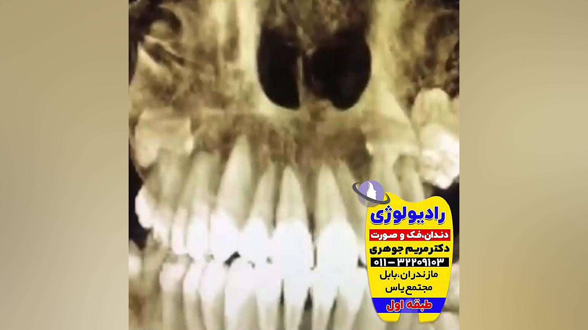 بهترین تصویربرداری دندان و دهان بابل و بابلسر | دکتر مریم جوهری دکتر مریم جوهری