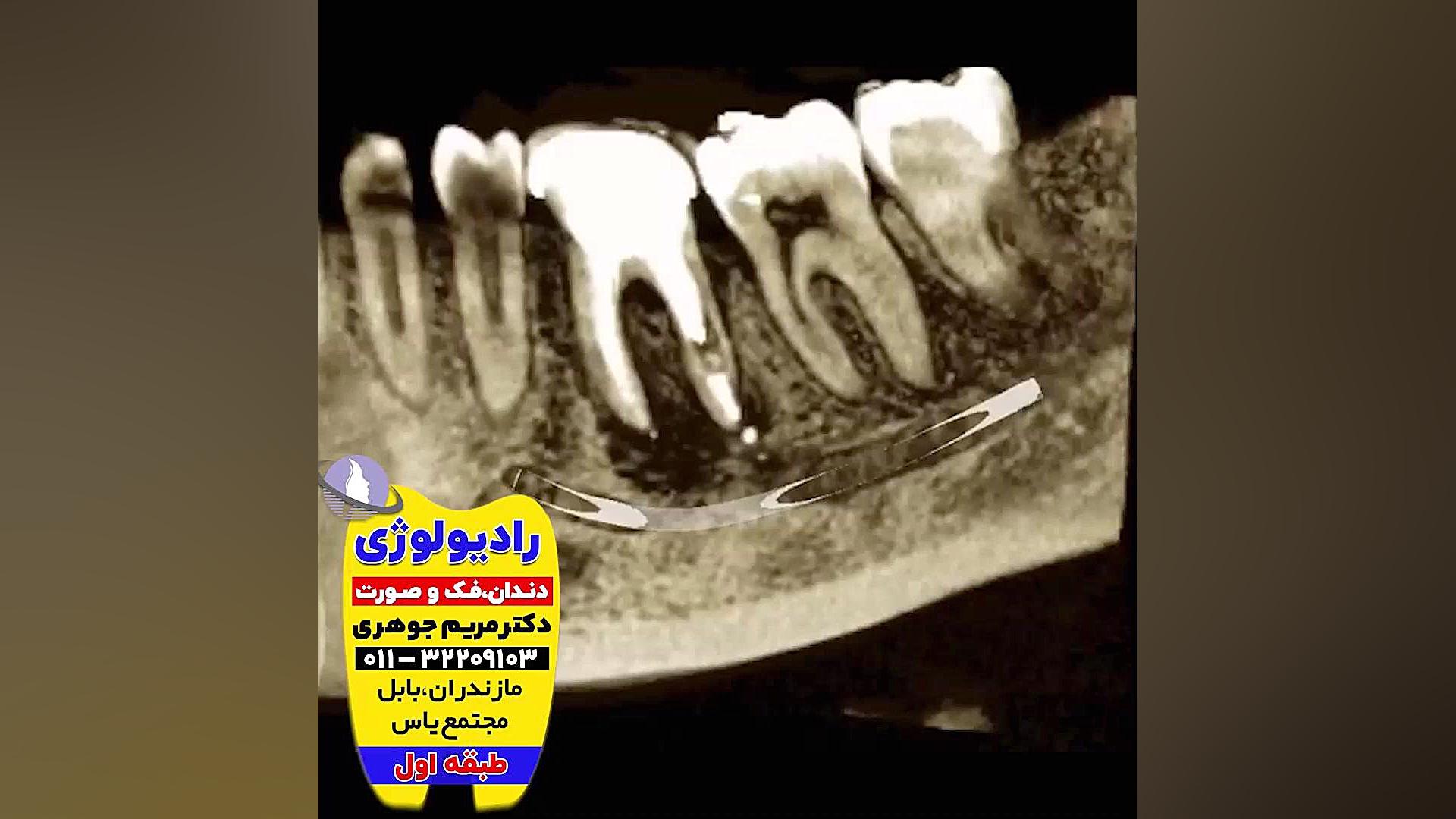 بهترین تصویربرداری دندان و دهان بابل و بابلسر | دکتر مریم جوهری دکتر مریم جوهری