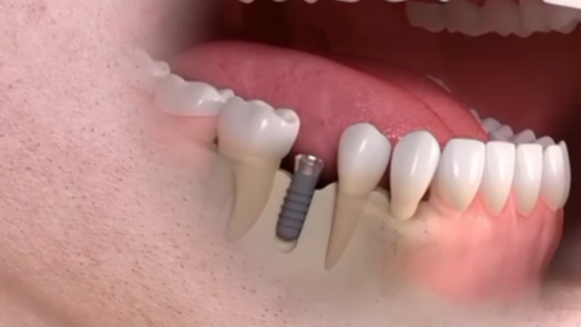 جایگزینی دندان با ایمپلنت دکتر امین جباری