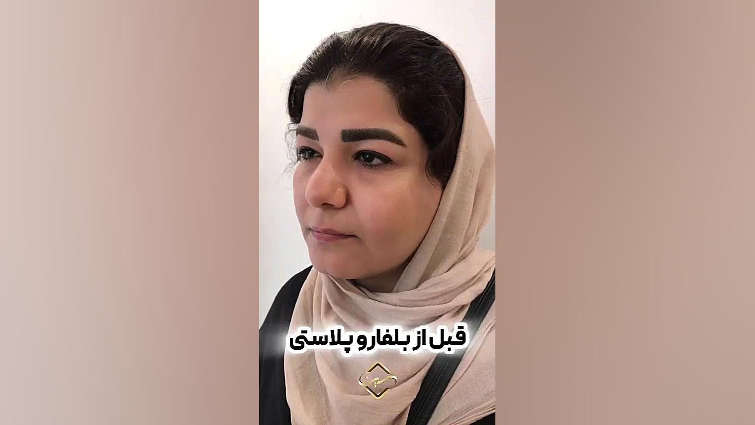 قبل و بعد از بلفاروپلاستی عصب‌کشی