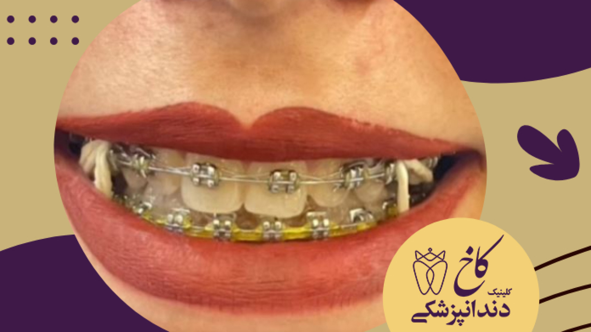 نمونه کار ارتودنسی بزرگسالان کلینیک دندانپزشکی کاخ