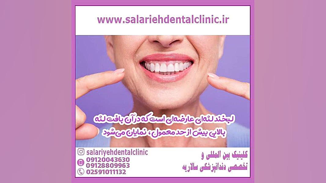 جراحی لثه برای اصلاح لبخند لثه ای اپی‌ژنتیک دارویی