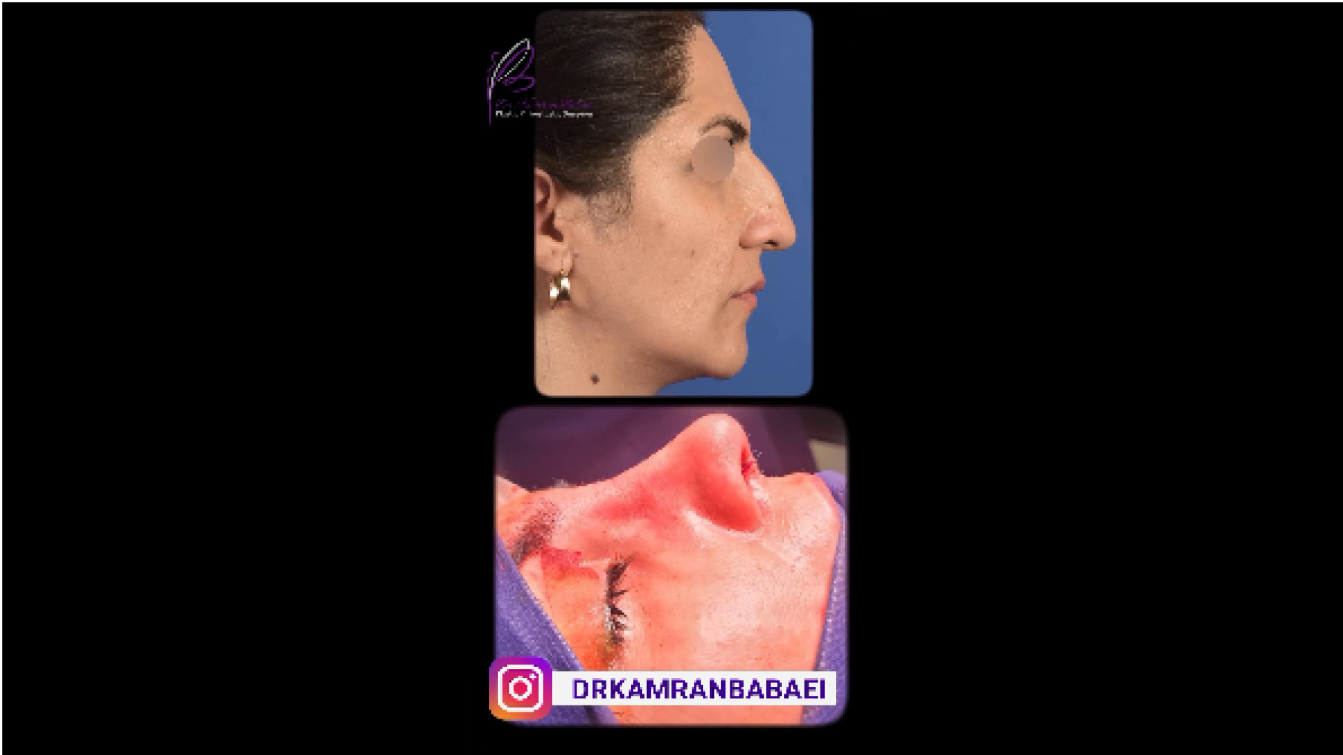 عمل زيبايى بينى دکتر کامران بابایی