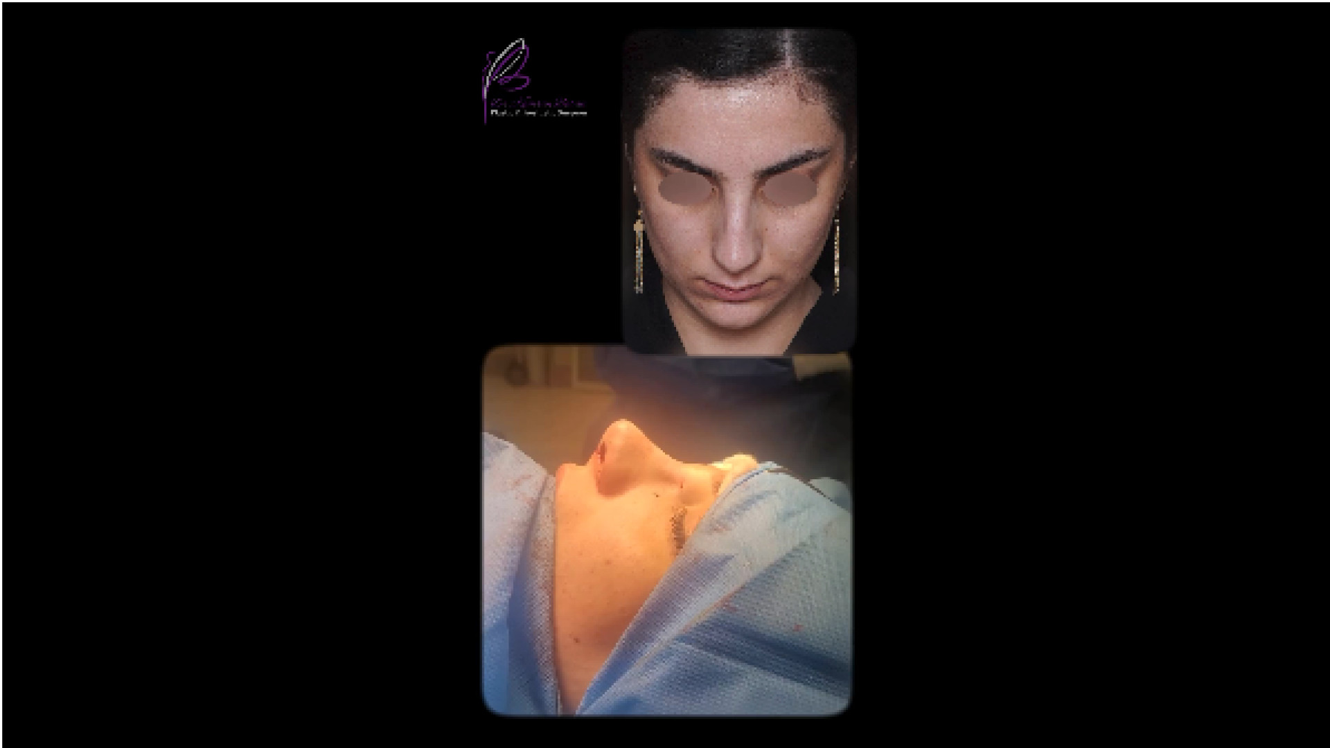 نمونه جراحى زيبايى بينى دکتر کامران بابایی