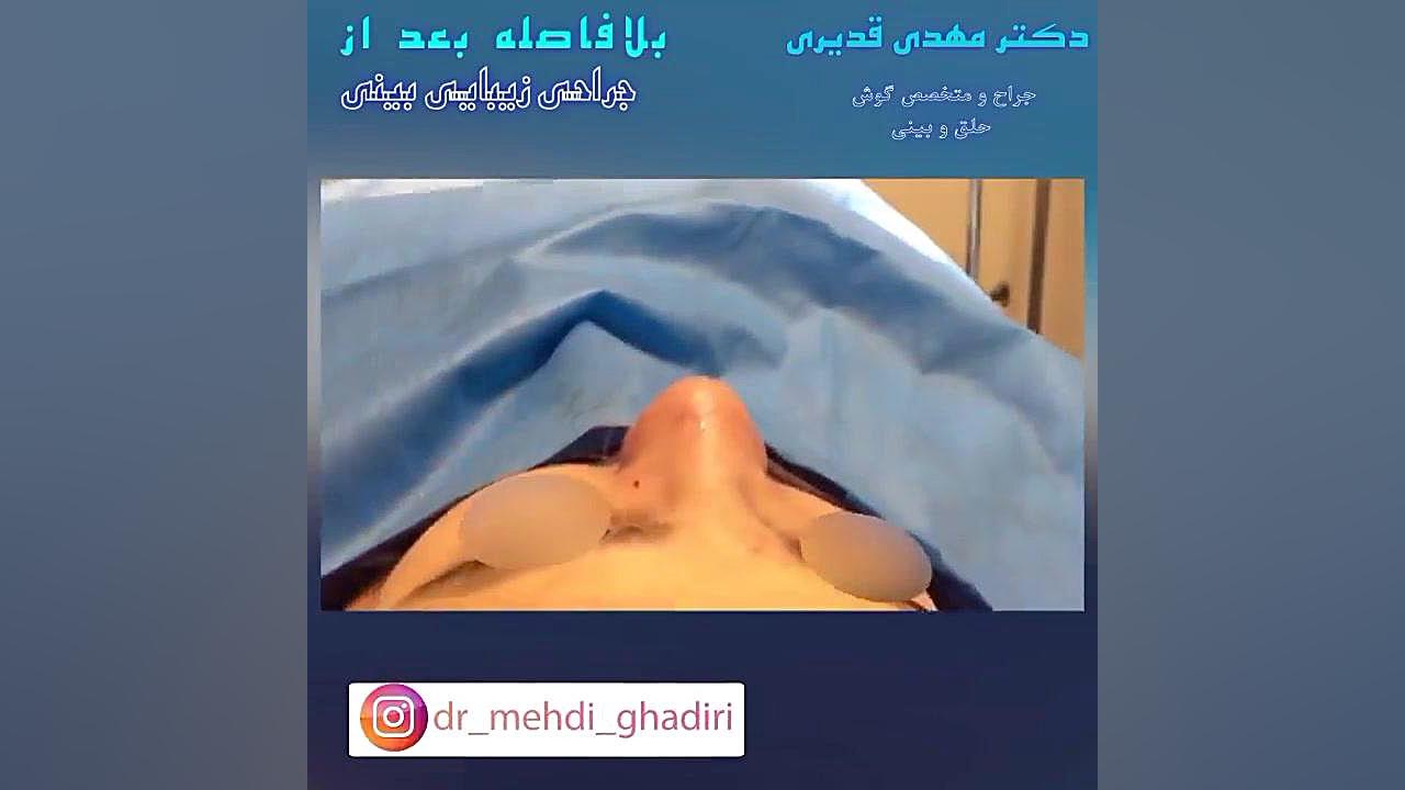 جراحی بینی دکتر مهدی قدیری