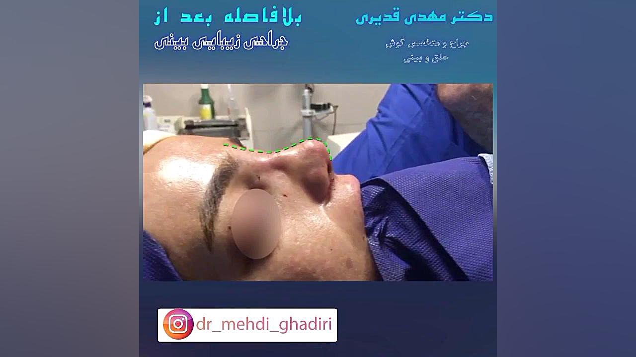 جراحی بینی | دکتر مهدی قدیری دکتر مهدی قدیری