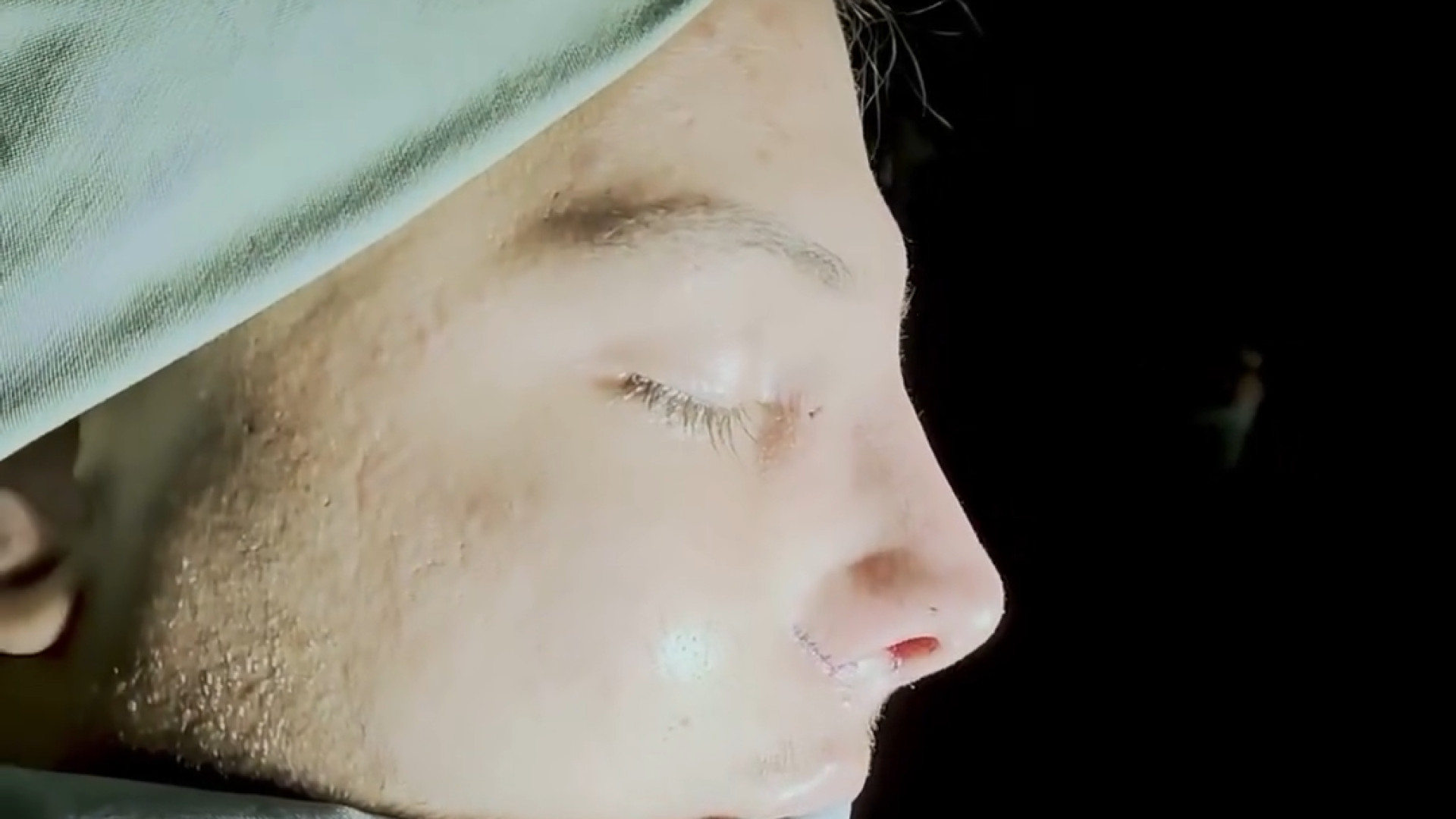 نمونه رینوپلاستی مردانه دکتر هاتف زیرک زاده - فوق تخصص جراحی پلاستیک