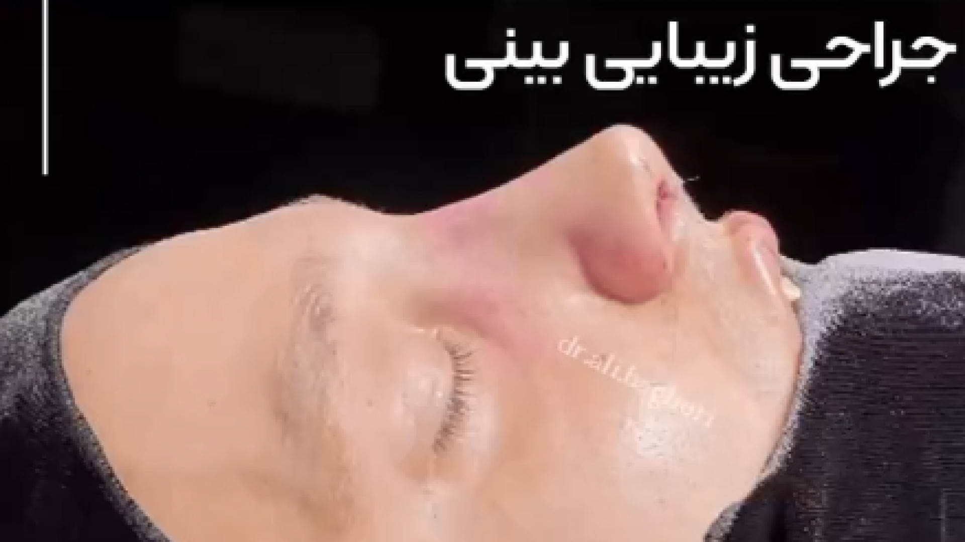 اصلاح بینی مردانه به صورت طبیعی | دکتر باقری حق دکتر علی باقری حق