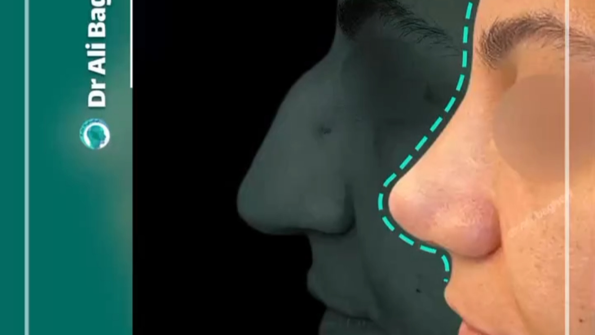 عمل بینی قوزدار | دکتر باقری حق دکتر علی باقری حق