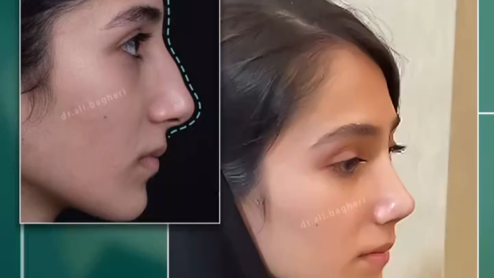 رینوپلاستی به صورت نیمه فانتزی | دکتر باقری حق دکتر علی باقری حق