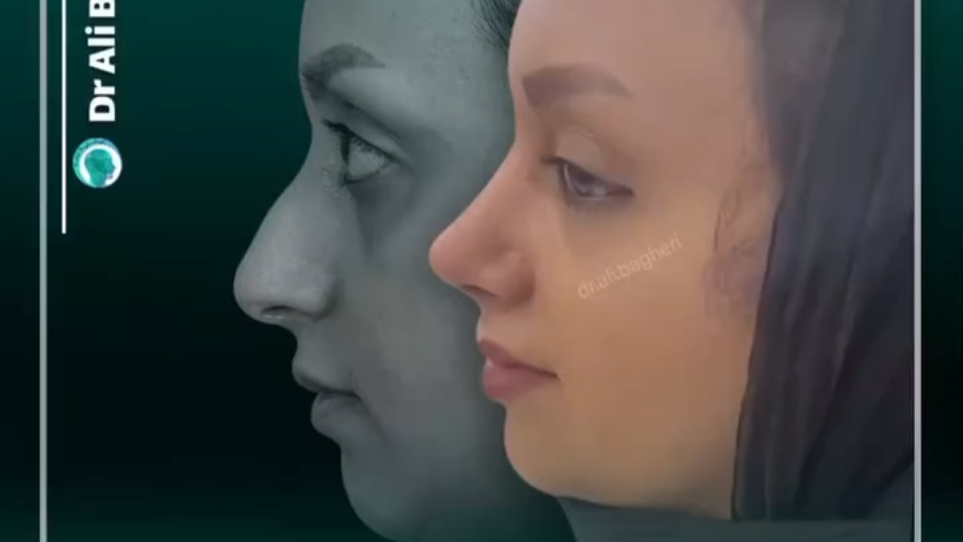 نتیجه عمل بینی | دکتر باقری حق دکتر علی باقری حق