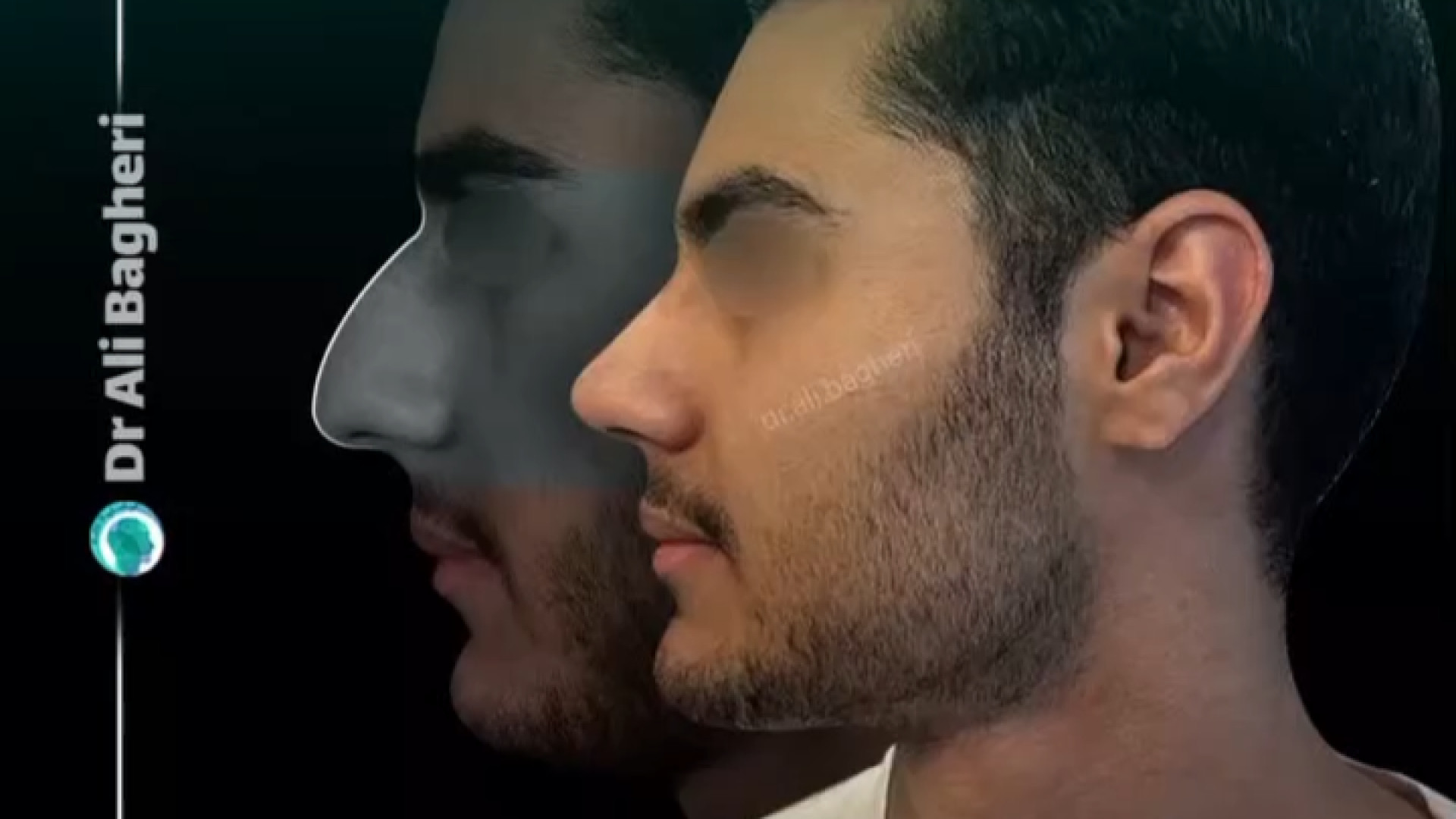عمل بینی مردانه و طبیعی | دکتر باقری حق دکتر علی باقری حق