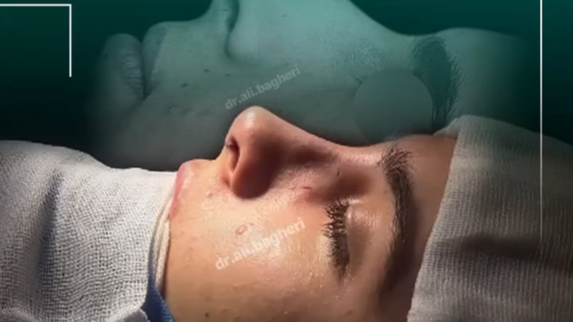 رینوپلاستی نچرال | دکتر باقری حق دکتر علی باقری حق