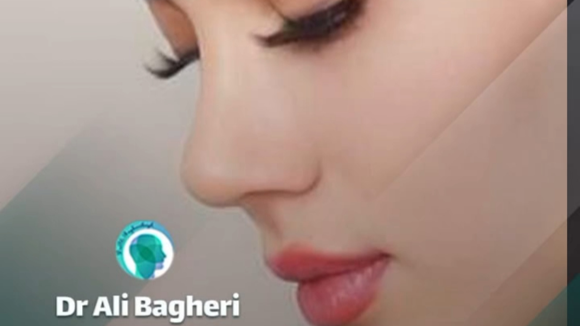 رضایت 5 ماه بعد از عمل بینی | دکتر باقری حق دکتر علی باقری حق