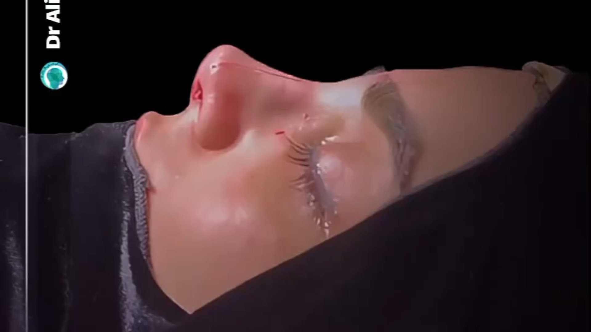 بلافاصله بعد از جراحی بینی | دکتر باقری حق دکتر علی باقری حق