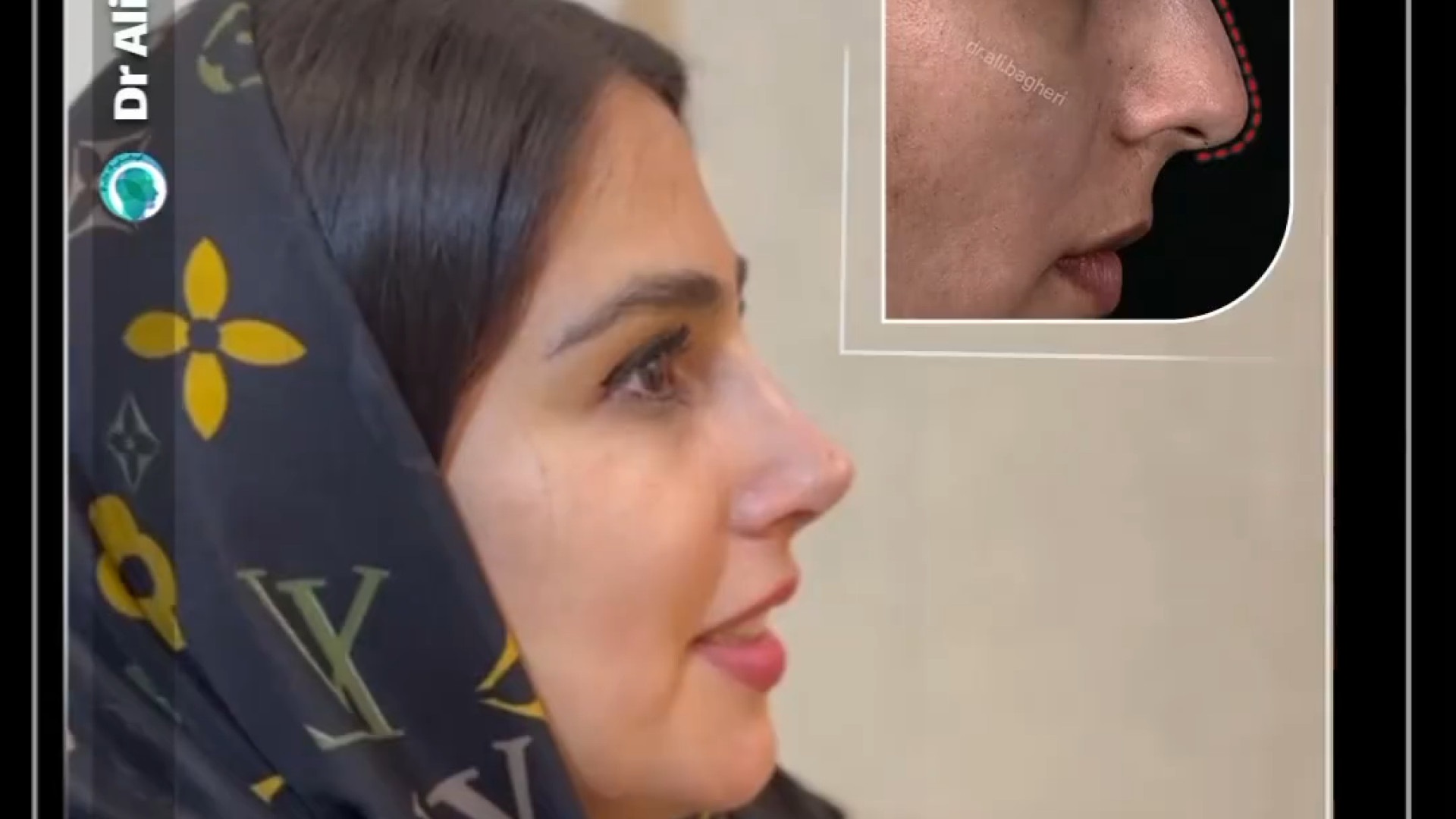 نمونه عمل بینی | دکتر باقری حق دکتر علی باقری حق