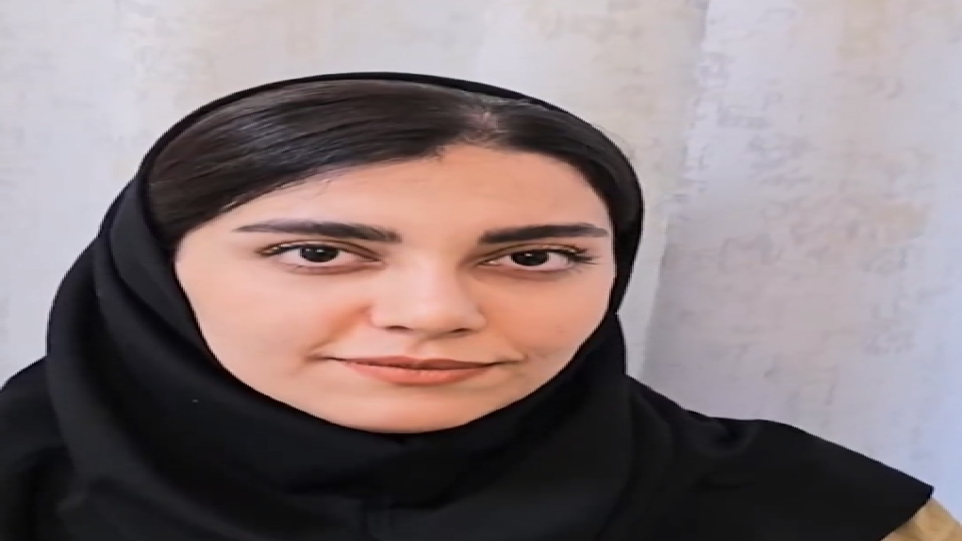 نتیجه فوق العاده سپتو رینوپلاستی توسط دکتر علی عقیلی دکتر علی عقیلی - جراح بینی در تهران