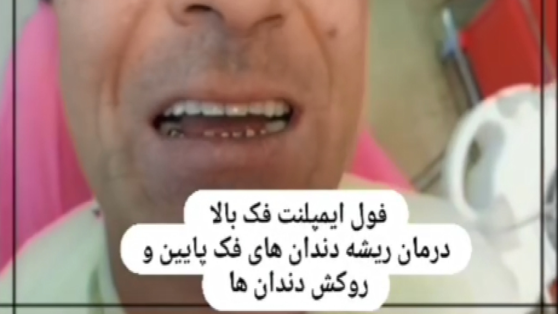 فول ایمپلنت فک بالا و درمان ریشه دندان های فک پایین و روکش دندان ها سندرم چیلبلینز